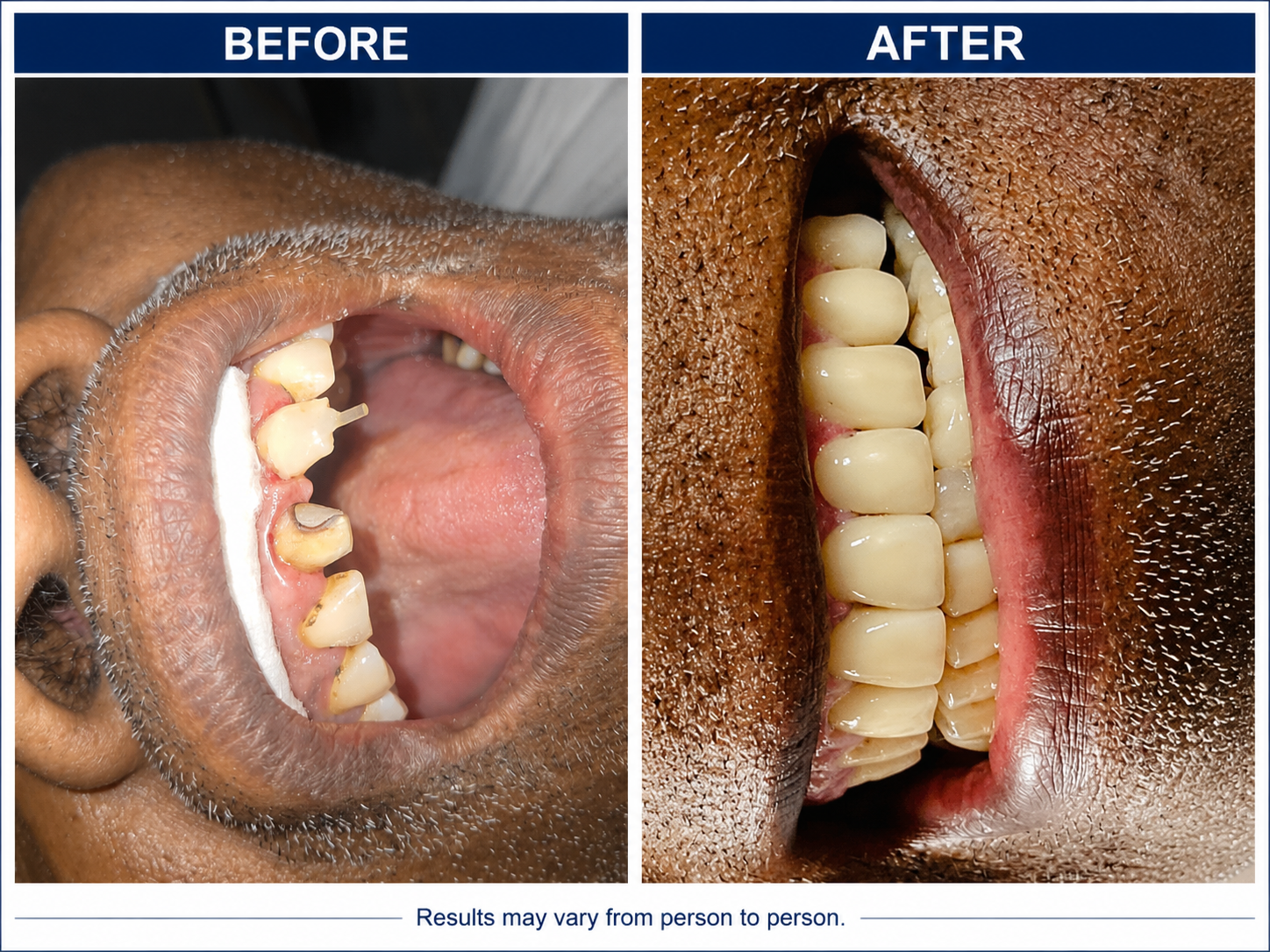 Before and after — Fixed Ceramic Bridge Restoration